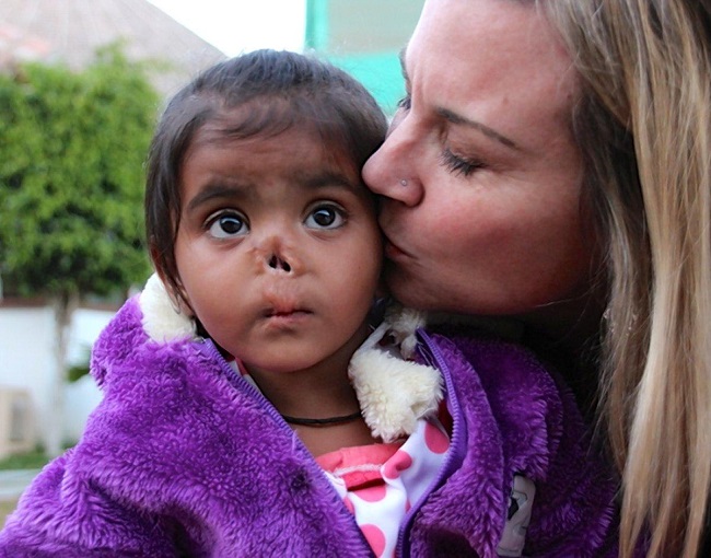 baby with an eaten nose baby with an eaten nose